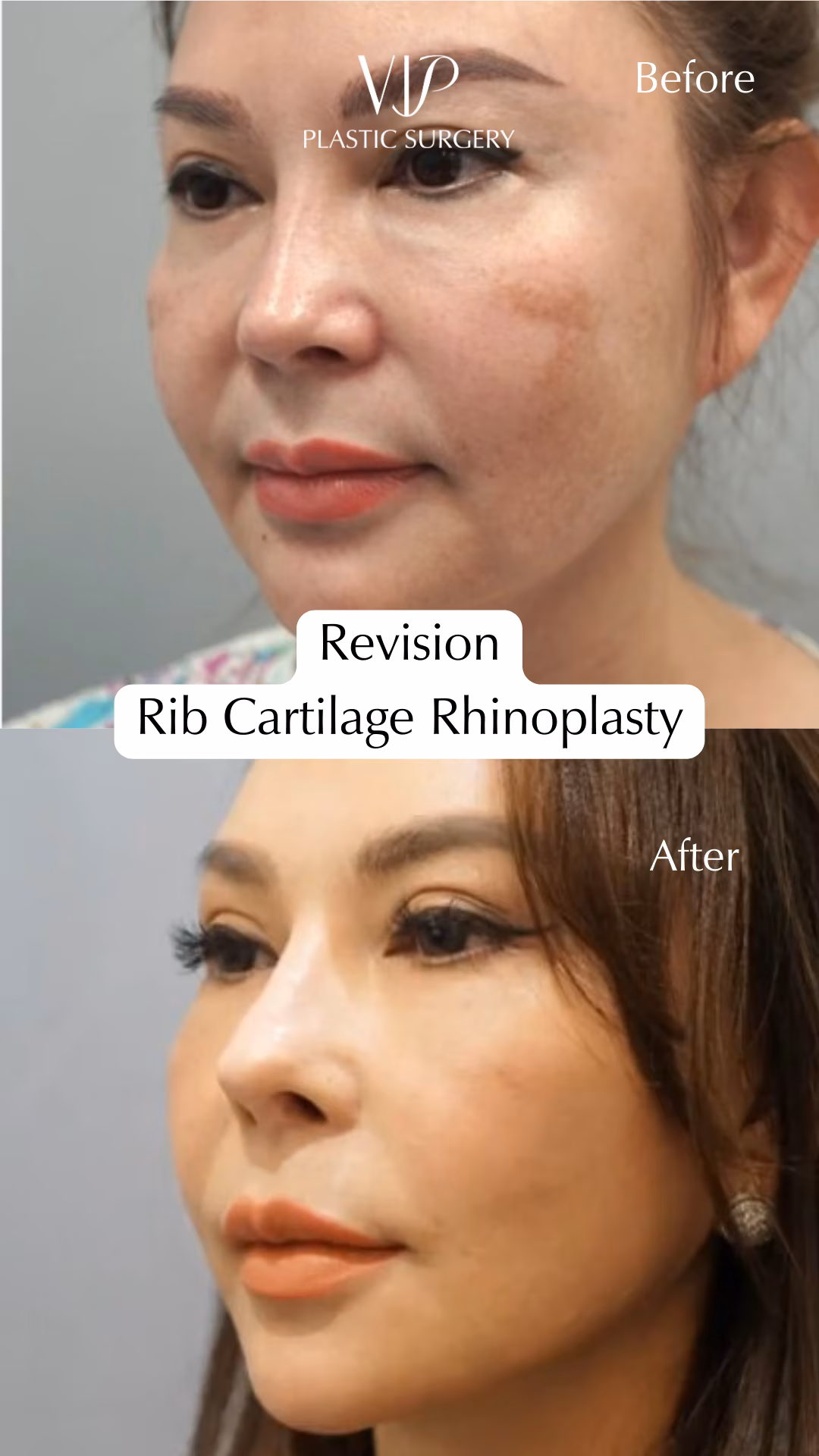 Rhinoplasty &amp; Extended Deep Plane Facelift Transformation Video