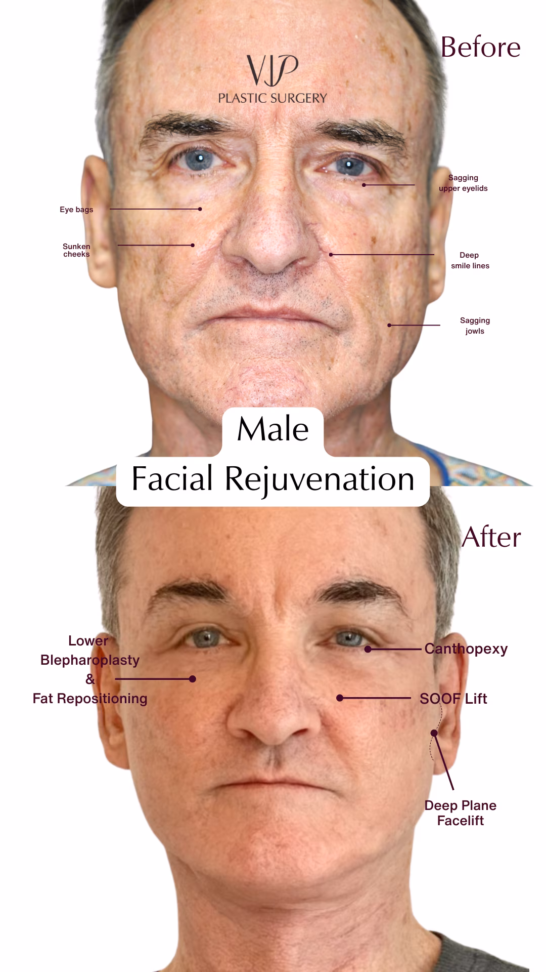 Eyelid Surgery, Facelift, Necklift Before &amp; After Video