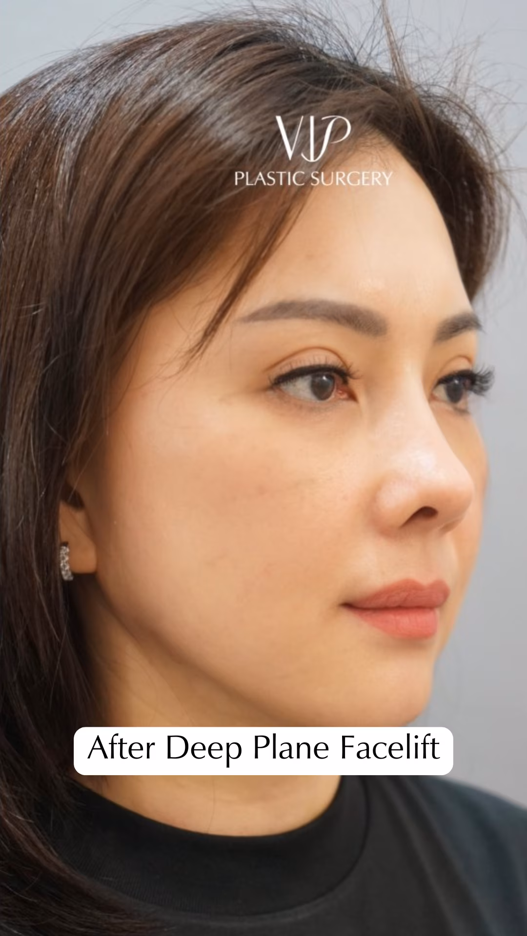 Deep Plane Facelift for Asian Female Patient Video